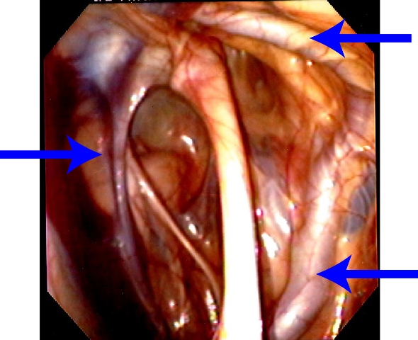 Guttural Pouch Mycosis