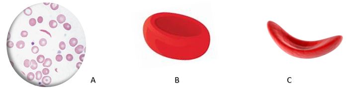 SCD Blood Cell Transformation